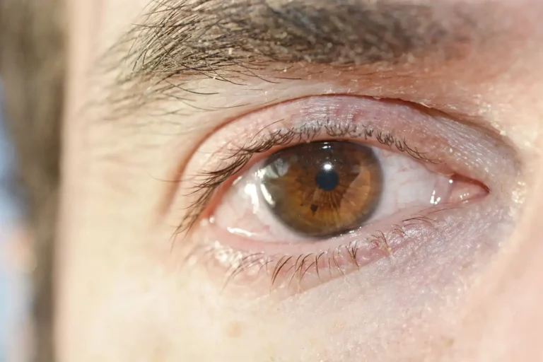 Percer un orgelet : pourquoi il vaut mieux s&rsquo;abstenir